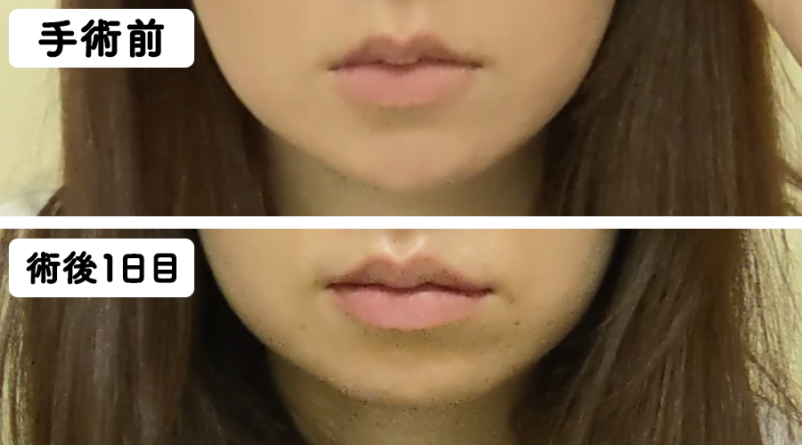 唇の腫れの比較